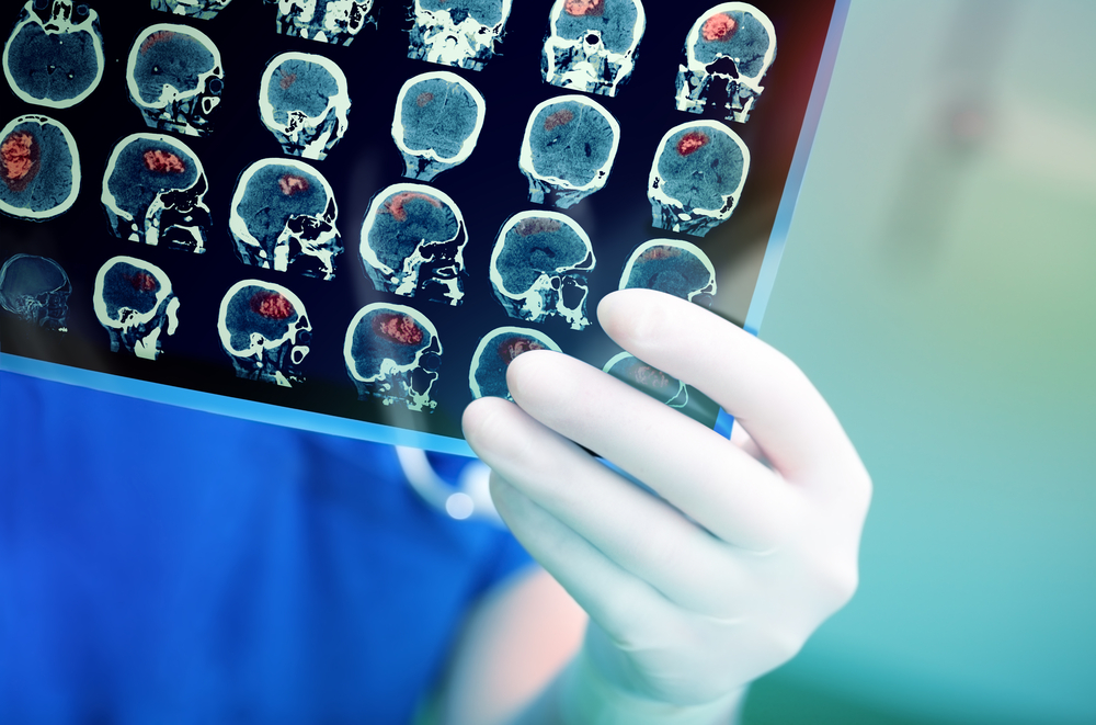 What Causes Brain Cancer? I Immunity Therapy Center